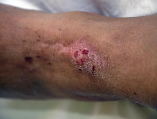 Dust mite excreta may cause eczema.