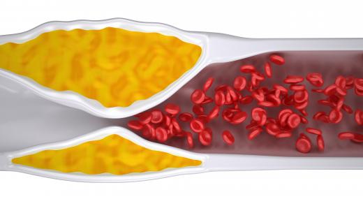 Nanoscale medical devices could be used to clear deadly plaque out of arteries.