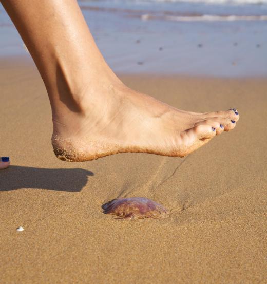 Acetic acid, which is found in vinegar, is a popular treatment for jellyfish stings.