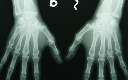 X-rays are high electromagnetic frequency waves used to look inside the human body.
