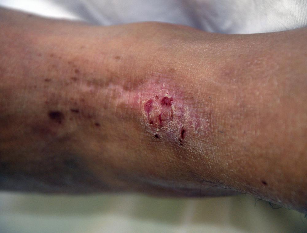 What are Mites? (with pictures)