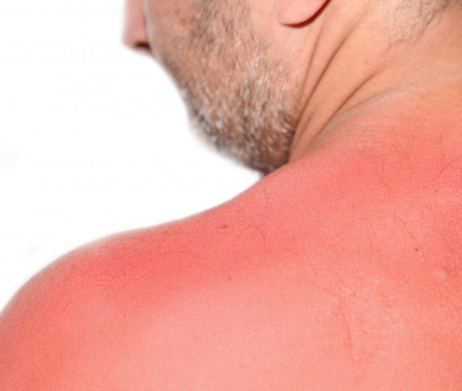 What Are the Dangers of Sulfuric Acid? (with pictures)