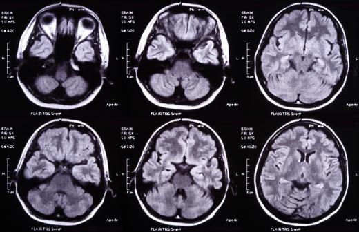 Psychological disorders like schizophrenia and depression can be detected through fMRI brain scans.